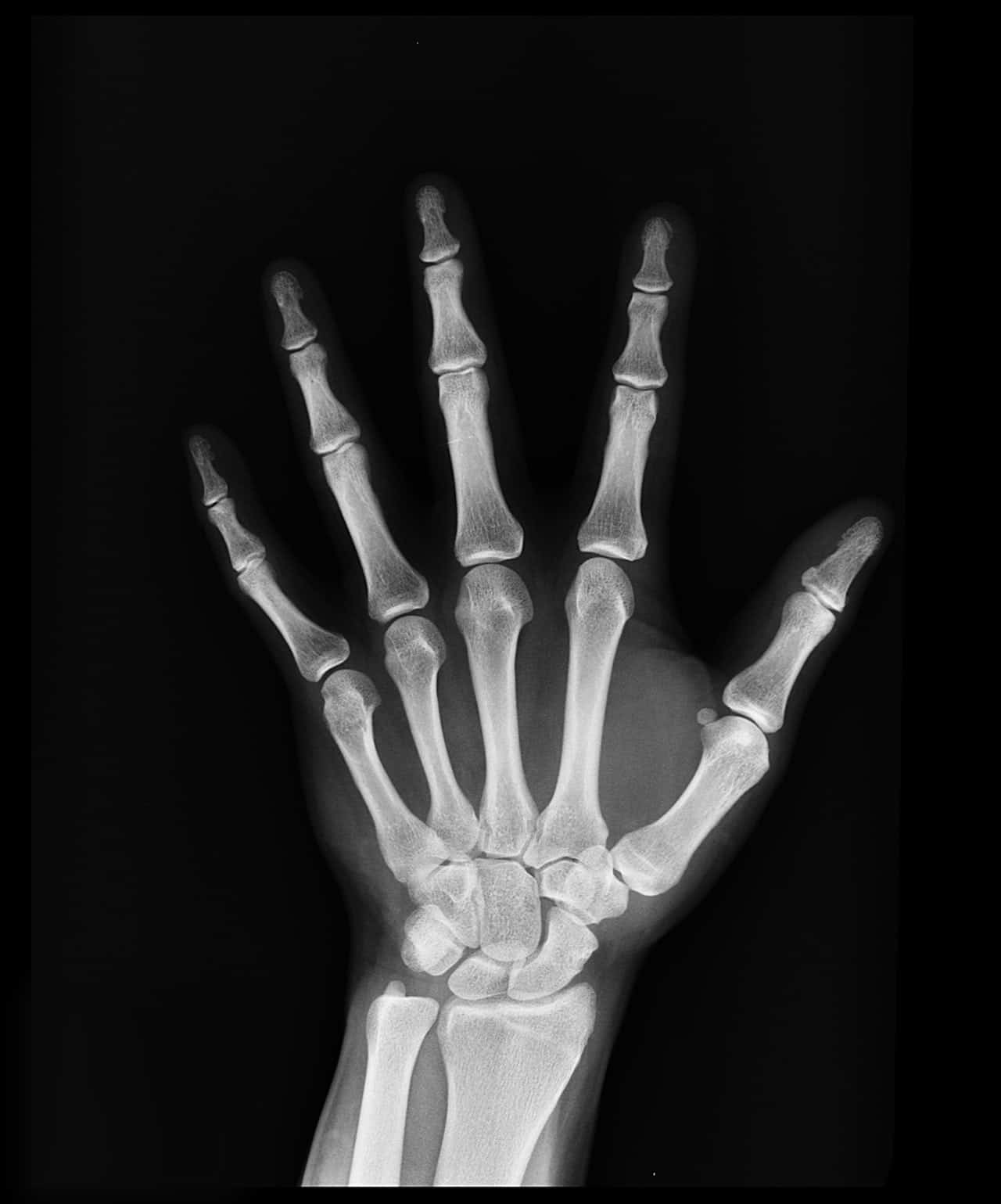 x-ray hand | black rock advanced medical imaging | gillette wyoming